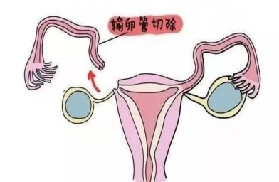 郑州慈铭博鳌国际医院三代试管婴儿，切除双侧输卵管还能做试管婴儿吗？