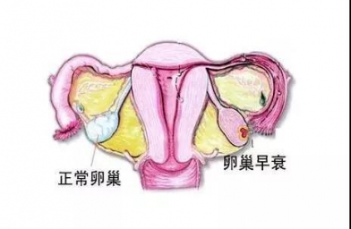 郑州备孕试管婴儿知识_为什么年轻女性也会卵巢早衰？如何防止早衰？